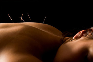 Acupuncture